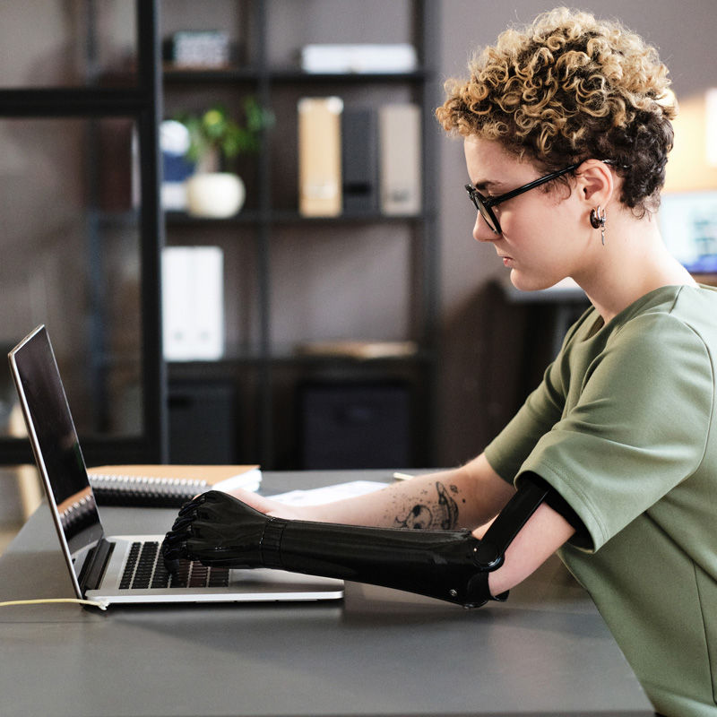 A young professional with a prosthetic arm working on a laptop.